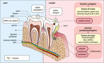 Microbiote buccal et évolution vers la parodontite - crédits : Encyclopædia Universalis France