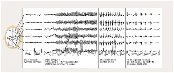 Crise tonico-clonique : enregistrement électro-encéphalographique - crédits : Encyclopædia Universalis France