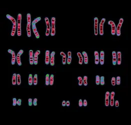 Caryotype d’un syndrome de Klinefelter - crédits : Wessex Reg. Genetics Centre/ Wellcome Collection (CC BY)