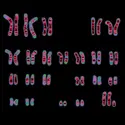 Caryotype d’un syndrome de Klinefelter - crédits : Wessex Reg. Genetics Centre/ Wellcome Collection (CC BY)