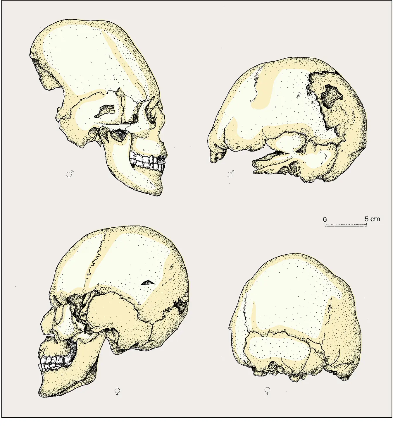 Exemples de crânes déformés (1)
