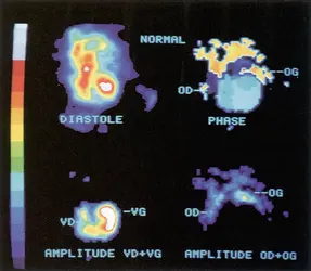 Traitement mathématique d'images numérisées - crédits : service de médecine nucléaire, hôpital du Haut-Lévêque, Pessac, Gironde