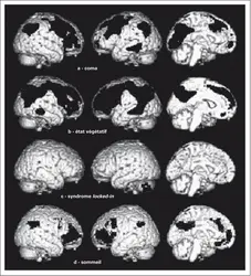 Cerveau humain et états de conscience - crédits : Encyclopædia Universalis France