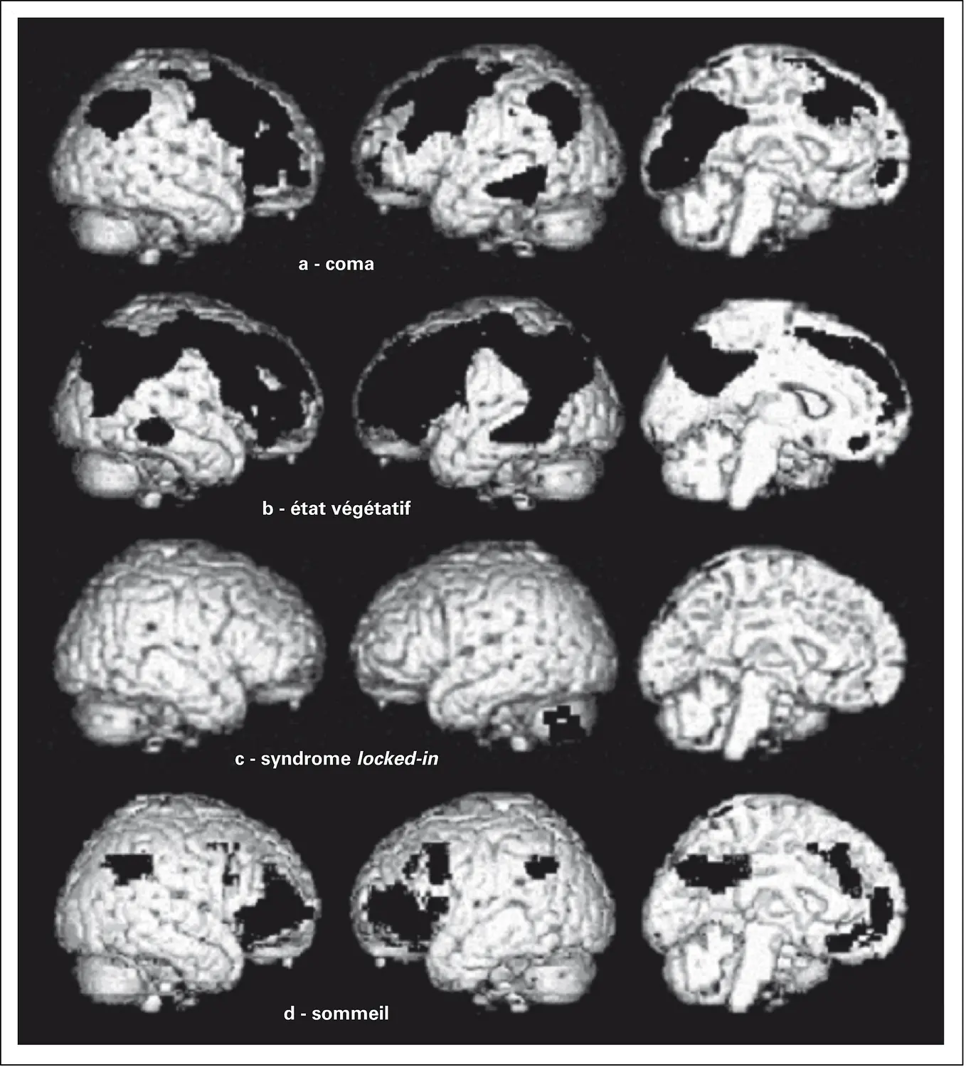 Cerveau humain et états de conscience