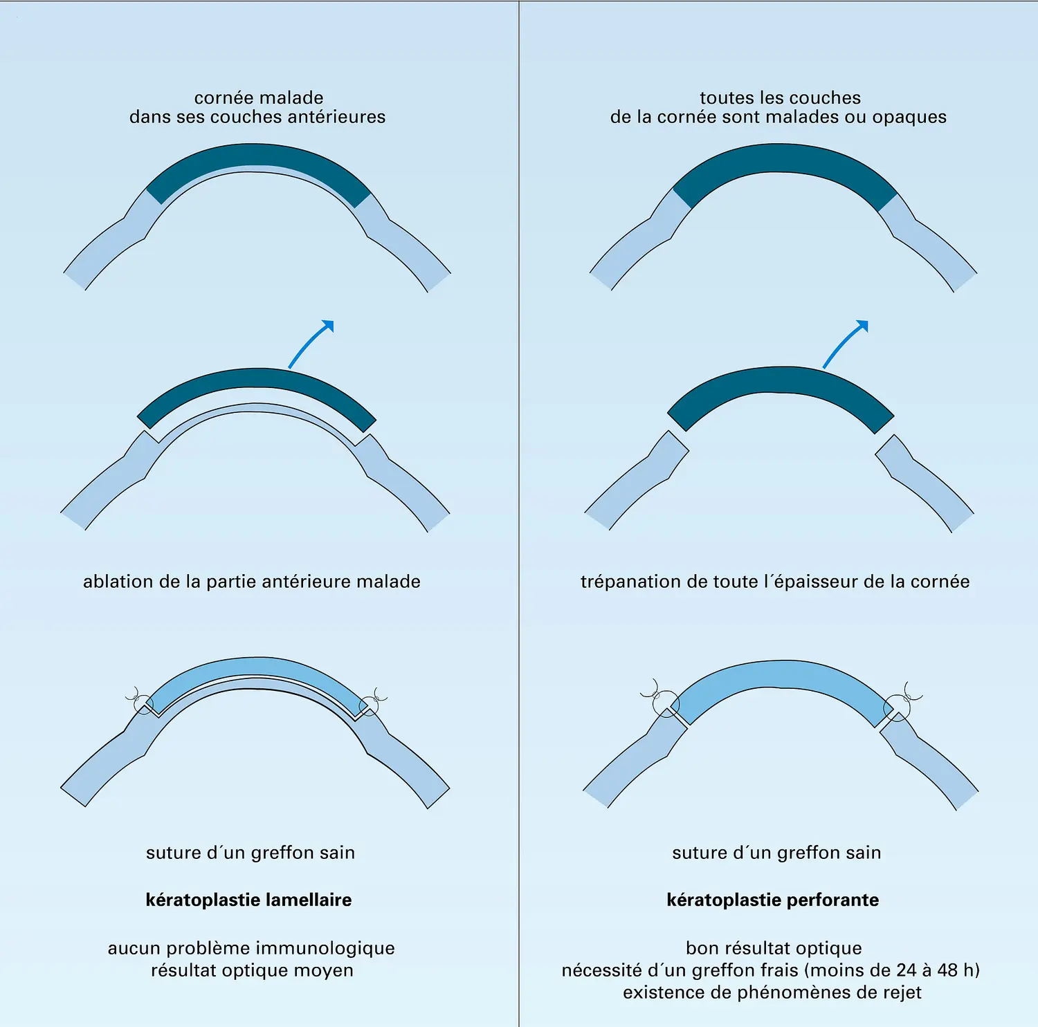 Kératoplasties