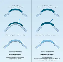 Kératoplasties - crédits : Encyclopædia Universalis France