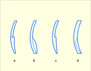 Verres bifocaux : types divers - crédits : Encyclopædia Universalis France