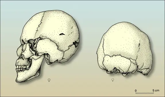Exemples de crânes déformés (2)