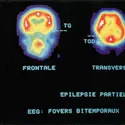 Débit sanguin cérébral analysé par tomoscintigraphie - crédits : service de médecine nucléaire, hôpital du Haut-Lévêque, Pessac, Gironde