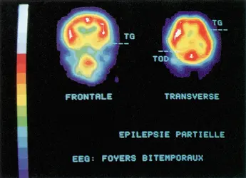 Débit sanguin cérébral analysé par tomoscintigraphie - crédits : service de médecine nucléaire, hôpital du Haut-Lévêque, Pessac, Gironde
