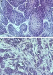 Métastases - crédits : B. Boyer, Institut Curie