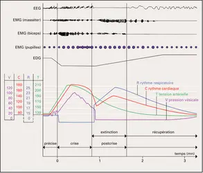 Crise tonico-clonique : enregistrement polygraphique - crédits : Encyclopædia Universalis France
