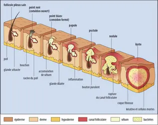 Évolution des lésions de l’acné - crédits : Encyclopædia Universalis France