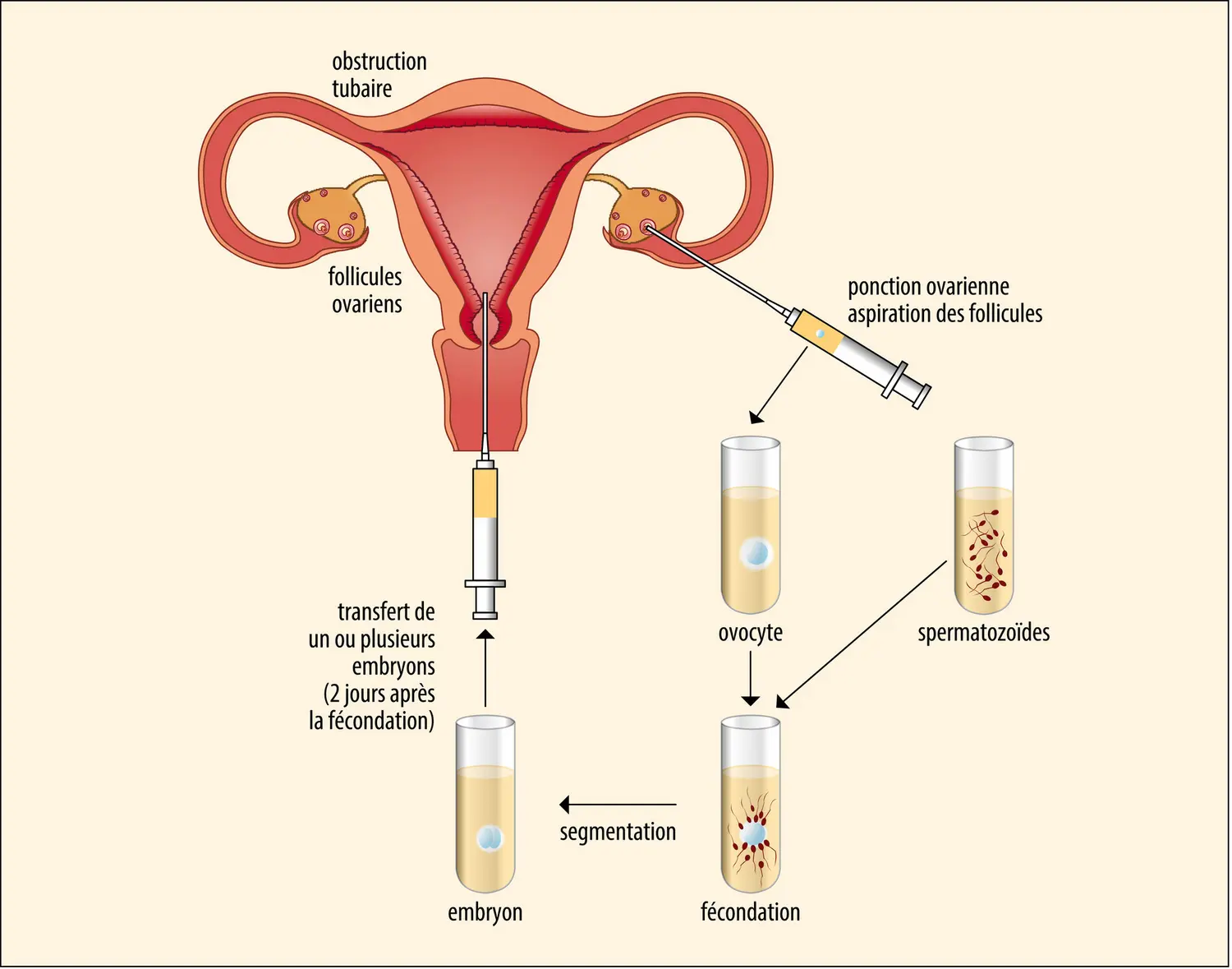 Schéma de la fécondation in vitro