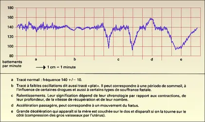 Fréquence cardiaque fœtale - crédits : Encyclopædia Universalis France