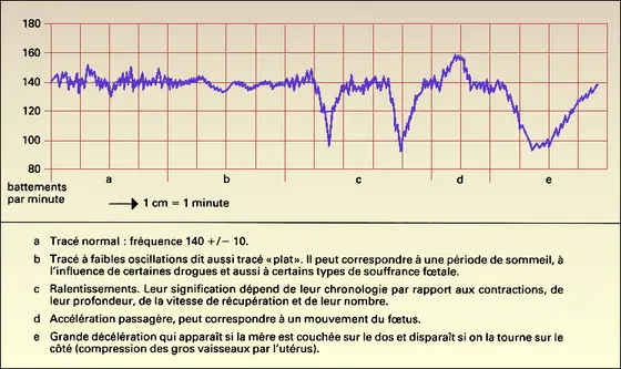 Fréquence cardiaque fœtale