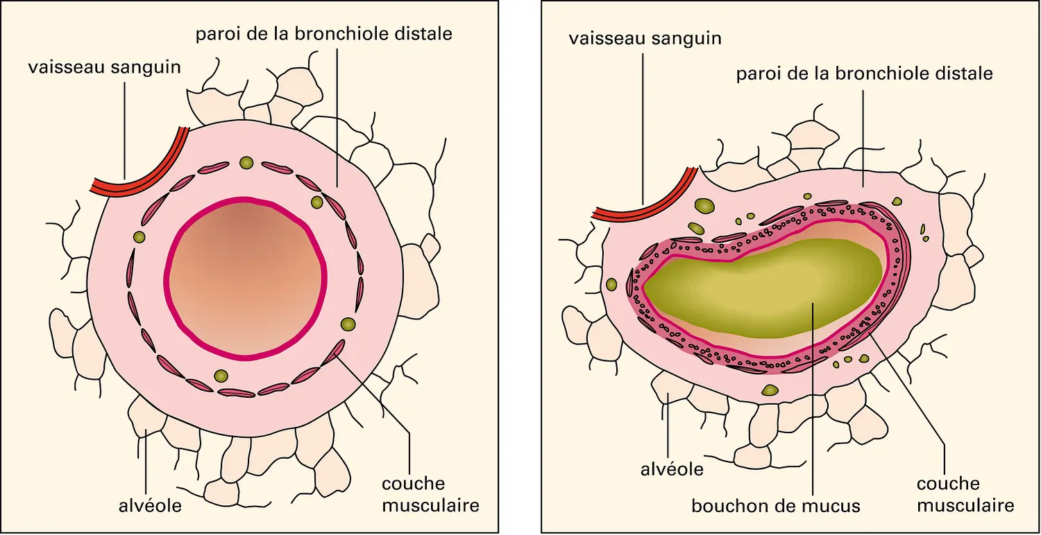 Anatomie comparée d'une bronche d'un sujet normal et d'un sujet asthmatique