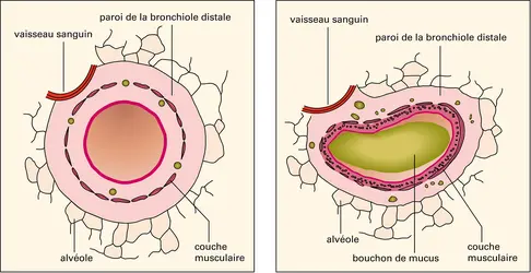 Anatomie comparée d'une bronche d'un sujet normal et d'un sujet asthmatique - crédits : Encyclopædia Universalis France