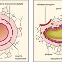 Anatomie comparée d'une bronche d'un sujet normal et d'un sujet asthmatique - crédits : Encyclopædia Universalis France