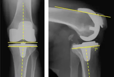 Axes mécaniques du tibia et du fémur - crédits : E. Stindel