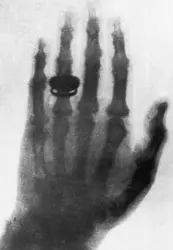 Radiographie prise par Wilhelm Röntgen - crédits : Hulton Archive/ Getty Images