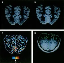 IRM fonctionnelle du cortex visuel humain - crédits : © 1991 AAAS. Reprinted with permission from AAAS