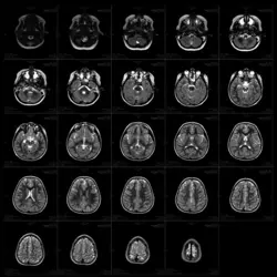 Imagerie par I.R.M. d'un cerveau humain - crédits : F. Kondratenko/ Shutterstock