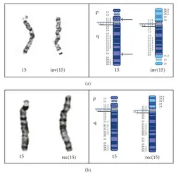 Chromosomes 15 humain normal et recombinant - crédits : © 2011 Rachel O'Connor et al. (CC BY 3.0), doi:10.1155/2011/898706 