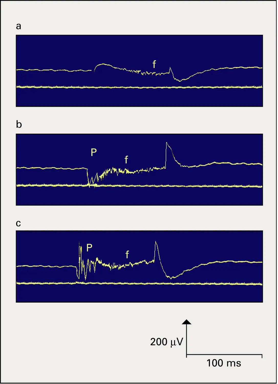 Électromyogrammes pathologiques