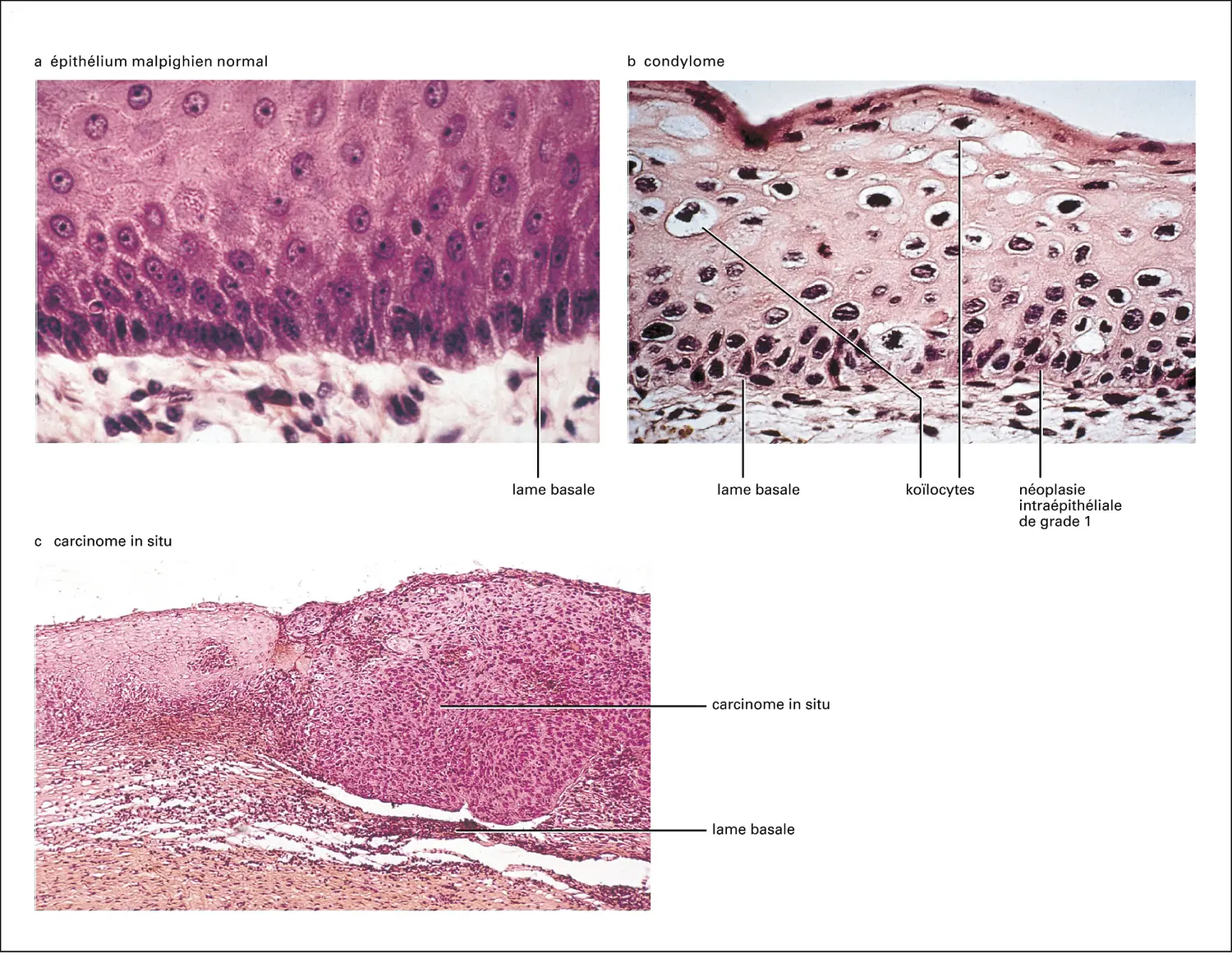 Papillomavirus : épithélium normal et lésions précancéreuses provoquées