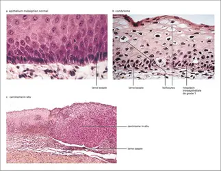 Papillomavirus : épithélium normal et lésions précancéreuses provoquées - crédits : Encyclopædia Universalis France