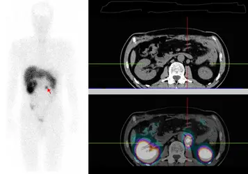 Scintigraphie à l'Octreoscan - crédits : service de médecine nucléaire, hôpital du Haut-Lévêque, Pessac, Gironde