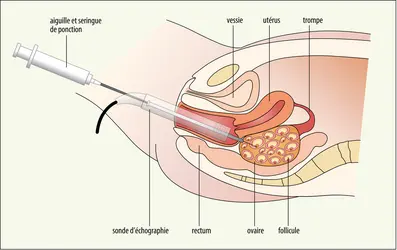 Prélèvement d’ovocytes par voie vaginale - crédits : Encyclopædia Universalis France