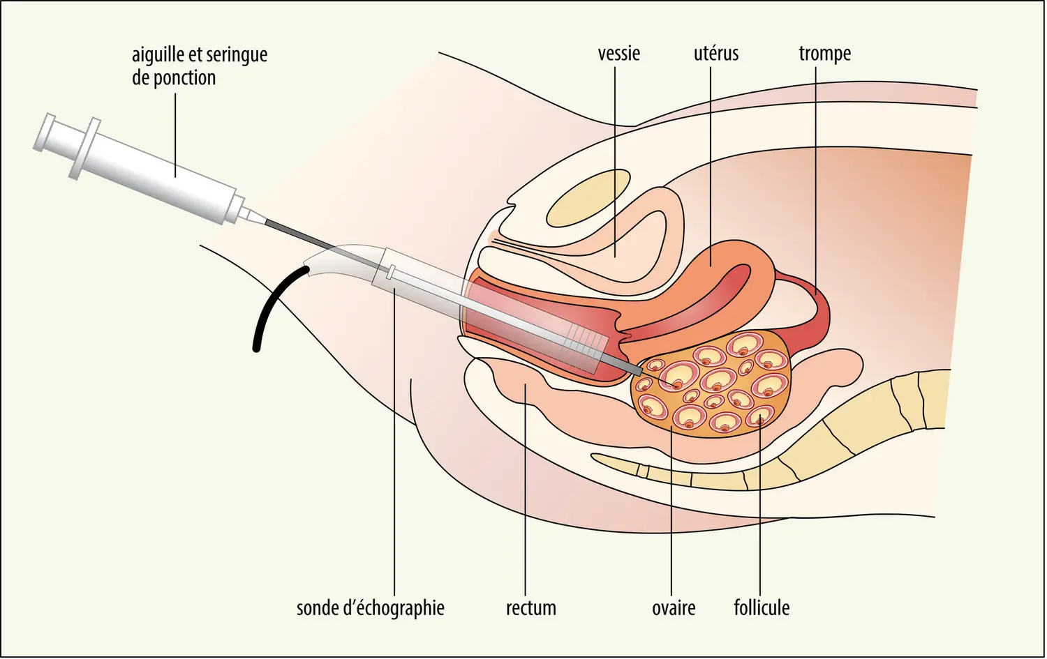 Prélèvement d’ovocytes par voie vaginale