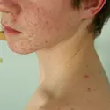 Exemple d’acné juvénile - crédits : BSIP