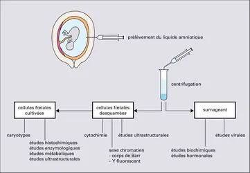 Amniocentèse - crédits : Encyclopædia Universalis France
