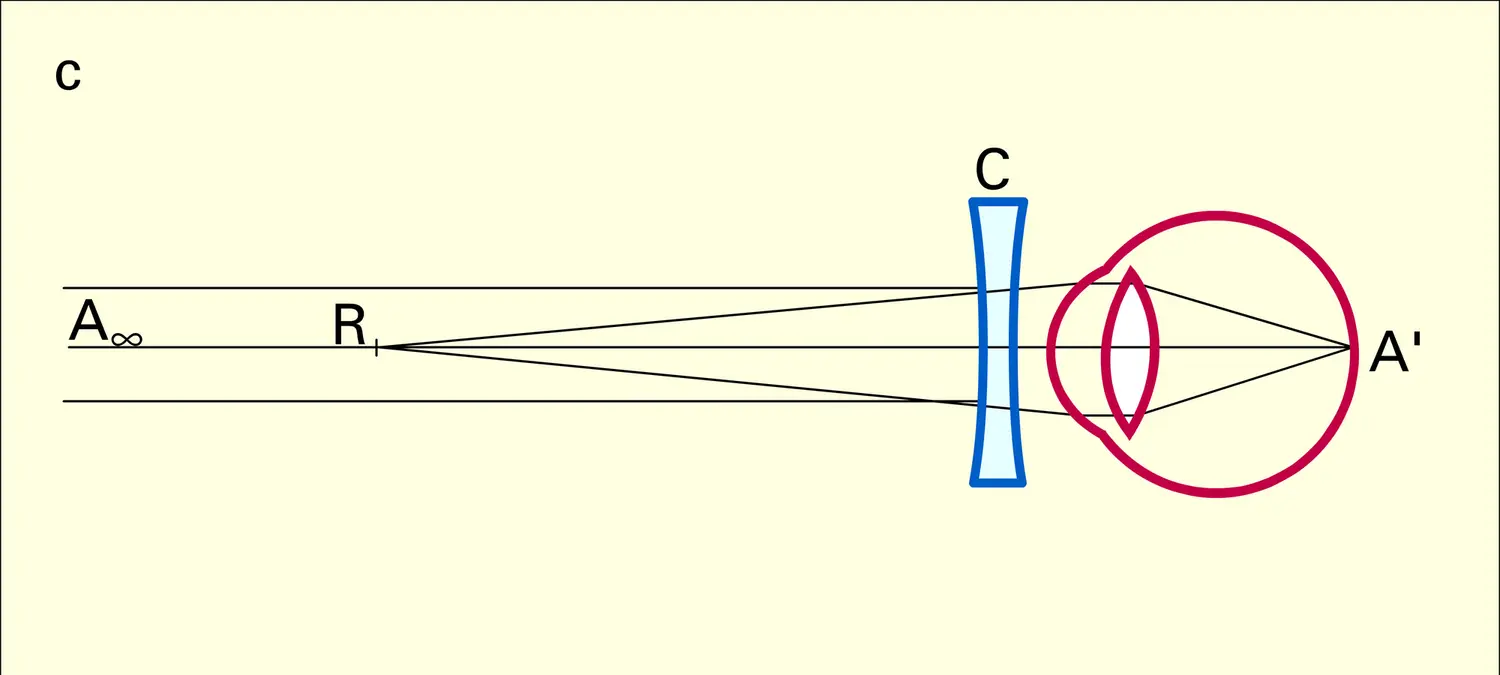 Non-accommodation : œil myope - vue 3