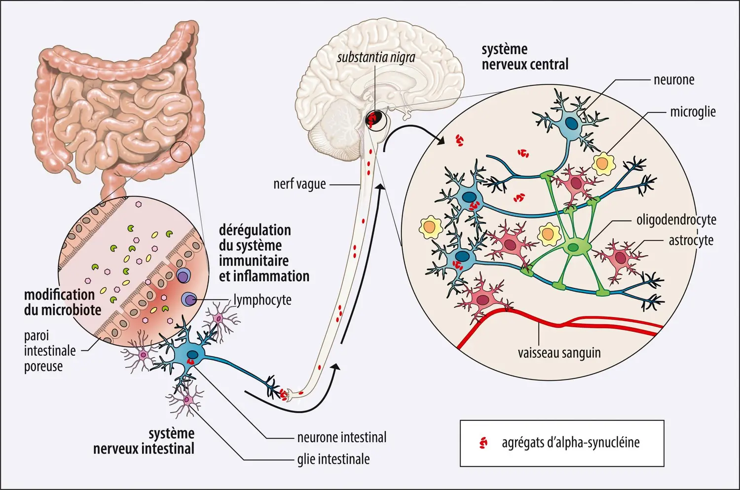 Lien possible entre inflammation intestinale et maladie de Parkinson