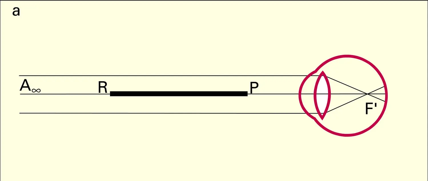 Non-accommodation : œil myope - vue 1