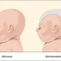 Têtes d’un bébé normal et d’un bébé microcéphale - crédits : Encyclopædia Universalis France