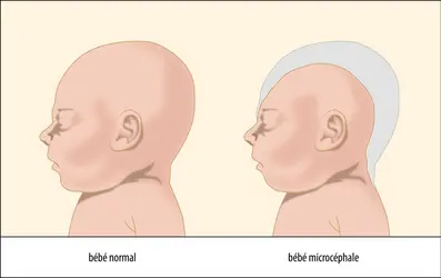 Têtes d’un bébé normal et d’un bébé microcéphale - crédits : Encyclopædia Universalis France