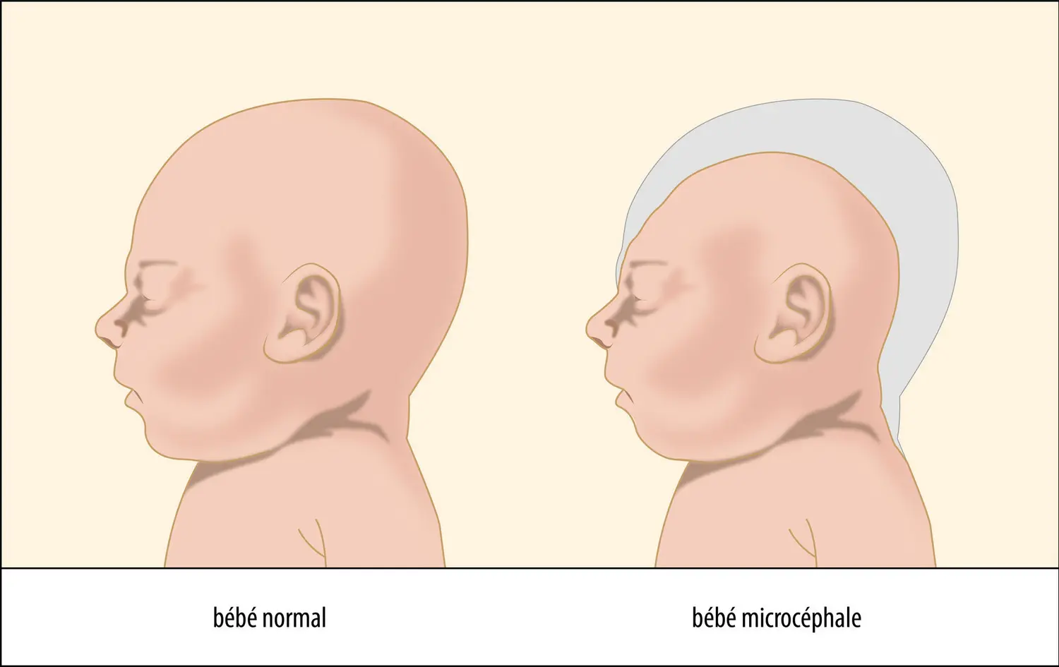 Têtes d’un bébé normal et d’un bébé microcéphale