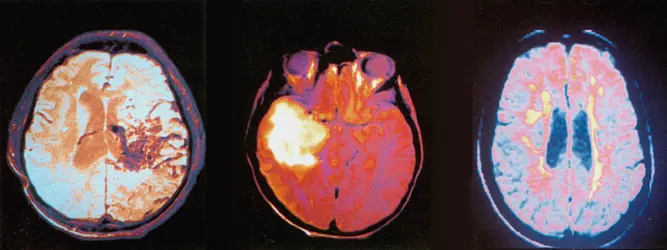 Imagerie I.R.M. cérébrale - crédits : M. Laval-Jeantet