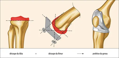 Découpes osseuses pour la mise en place d'une prothèse de genou - crédits : Encyclopædia Universalis France