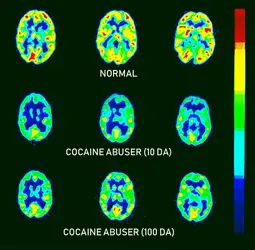 Activité cérébrale estimée par tomographie par émission de positons (TEP) - crédits : Brookhaven National Laboratory/ Science Source/ Getty Images