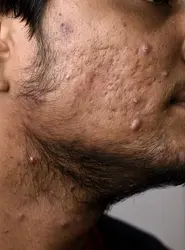 Cicatrices laissées par l’acné - crédits : Science Photo Library