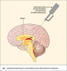 Thérapie cellulaire et génique de la maladie de Parkinson - crédits : Encyclopædia Universalis France