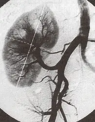 Angiographie numérique d'un rein greffé - crédits : M. Laval-Jeantet