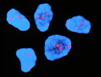 Détection d’une trisomie 21 - crédits : Science Photo Library/ AKG-images