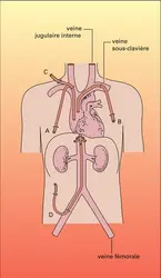 Nutrition artificielle : accès veineux - crédits : Encyclopædia Universalis France